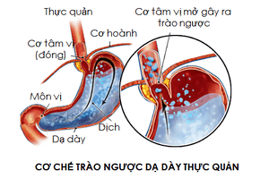 Viêm xoang trẻ em và bệnh trào ngược dạ dày – thực quản