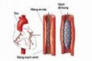 Stent - Cứu tinh của người bệnh mạch vành