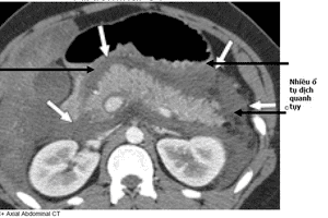 Xử trí kịp thời viêm tụy cấp