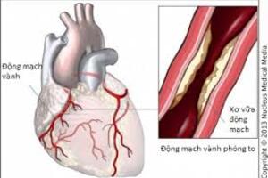 Cách phòng bệnh mạch vành